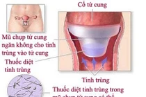 Mũ chụp tử cung tránh thai