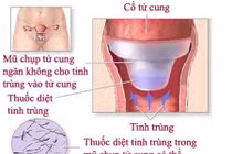 Mũ chụp tử cung tránh thai