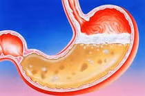 Rượu bia ảnh hưởng dạ dày như thế nào?