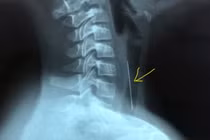 Bé 10 tuổi thủng khí quản vì nuốt nhầm cây kim