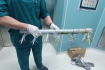 Bất cẩn ngã từ lầu hai, hàng rào sắt đâm thấu bụng