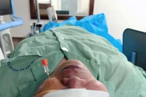 Tiêm cồn diệt hạch Gasser trị đau nửa mặt