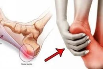 Bấm huyệt điều trị viêm đau gót chân