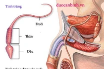 Vô tinh trùng do vi đứt đoạn NST Y