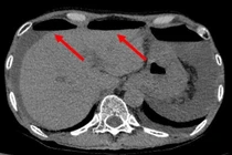 Cứu bệnh nhân sốc nhiễm trùng do thủng ruột