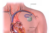 Suy tim độ 4 do hẹp hở van tim 