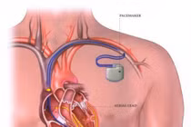 Suy tim độ 4 do hẹp hở van tim 