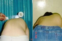 Điều trị vẹo cột sống tự phát