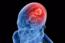 Ảnh minh họa ung thư não