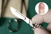 Hẹp bao quy đầu khi nào cần cắt?