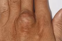 Đột biến gene lạ xuất hiện liên tiếp ở nhiều người trong cùng gia đình