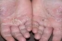 Tổ đỉa có tái phát?