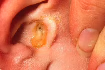  Liên tục viêm tai do dùng kháng sinh dự phòng