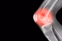 Biểu hiện của u xương sụn