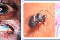 Cẩn thận ký sinh trùng gây mù mắt