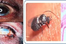 Cẩn thận ký sinh trùng gây mù mắt