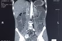 Tắc ruột vì thích ăn gỏi cá