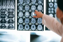 AI Việt chẩn đoán bệnh Alzheimer trong 10 phút