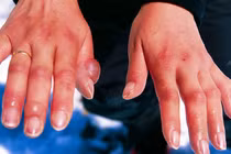 Bỏng lạnh cực nguy hiểm nếu không được sơ cứu đúng cách nhưng mọi người vẫn chưa nâng cao cảnh giác