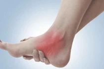 Điều trị bong gân khớp cổ chân tại nhà