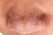 Thay đổi hormon kích thích mụn 