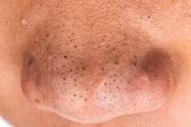 Thay đổi hormon kích thích mụn 