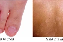 Cẩn thận với bệnh nấm chân trời nồm