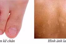 Cẩn thận với bệnh nấm chân trời nồm