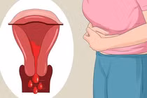 Lạc nội mạc trong cơ tử cung là gì? Triệu chứng và cách điều trị hiệu quả