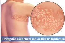 Thuốc trị bệnh zona cần được bác sĩ kê toa.