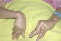 Tổn thương tuyến cận giáp 