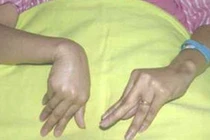 Tổn thương tuyến cận giáp 