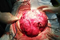 U quái ở trẻ nhỏ thường ác tính