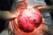 U quái ở trẻ nhỏ thường ác tính