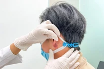 Tắc mạch hoại tử dái tai do tiêm filler trôi nổi tạo tai Phật 