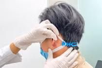 Tắc mạch hoại tử dái tai do tiêm filler trôi nổi tạo tai Phật 