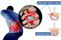 Dễ bại liệt, tàn phế nếu tự ý dùng thuốc chữa thoát vị đĩa đệm