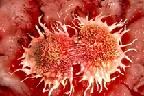 Các nhà khoa học đã tìm ra cách diệt tế bào ung thư