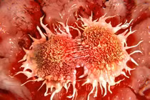 Các nhà khoa học đã tìm ra cách diệt tế bào ung thư