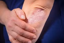 Bệnh vảy nến toàn thân và cách cải thiện hiệu quả