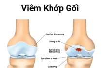 Ai dễ mắc viêm khớp gối? 