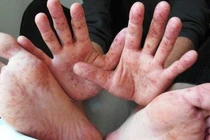 TPHCM: Yêu cầu các trường giám sát chặt chẽ khi bệnh chân tay miệng vào mùa