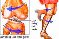  Đứt dây chằng chéo trước