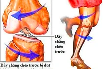  Đứt dây chằng chéo trước