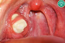 Không muốn cắt amidan vì đợi lớn tự át bệnh 