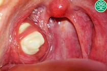 Không muốn cắt amidan vì đợi lớn tự át bệnh 