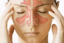 Viêm xoang không thể chữa qua loa