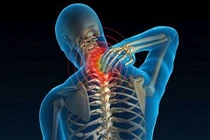 Đau vai gáy do bệnh nghề nghiệp