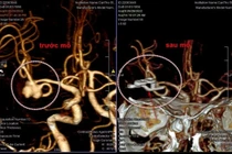 Hình ảnh sau mổ cho thấy đã kẹp hoàn toàn cổ của túi phình, ngăn chặn dòng máu vào túi phình hiệu quả.