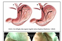 Ba biến chứng của trào ngược thực quản